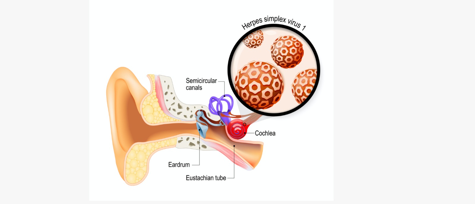 Inflammation that disrupts the inner ear’s delicate structures can connect migraines to hearing loss